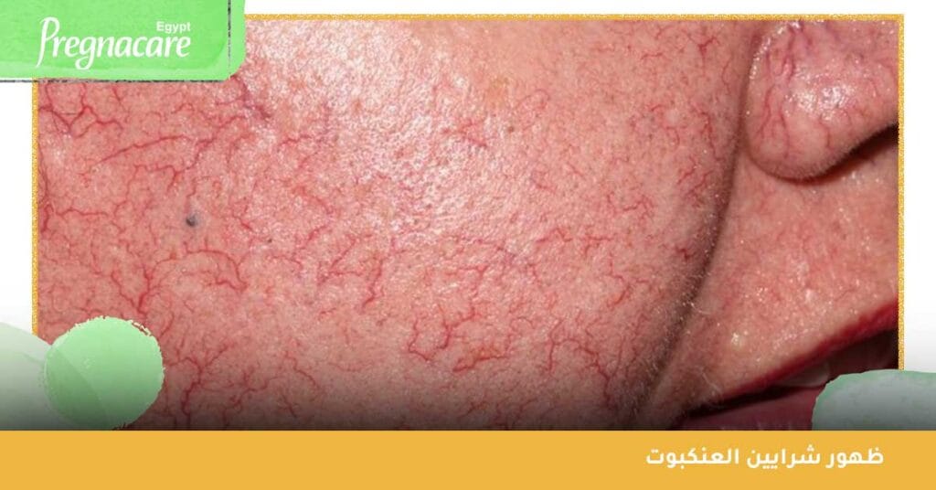 ظهور شرايين العنكبوت