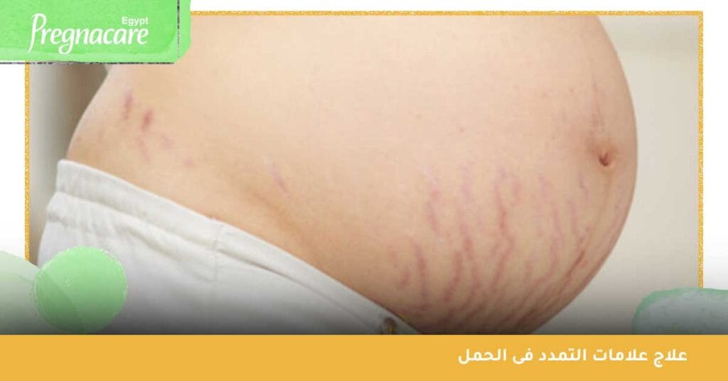 علاج علامات التمدد فى الحمل