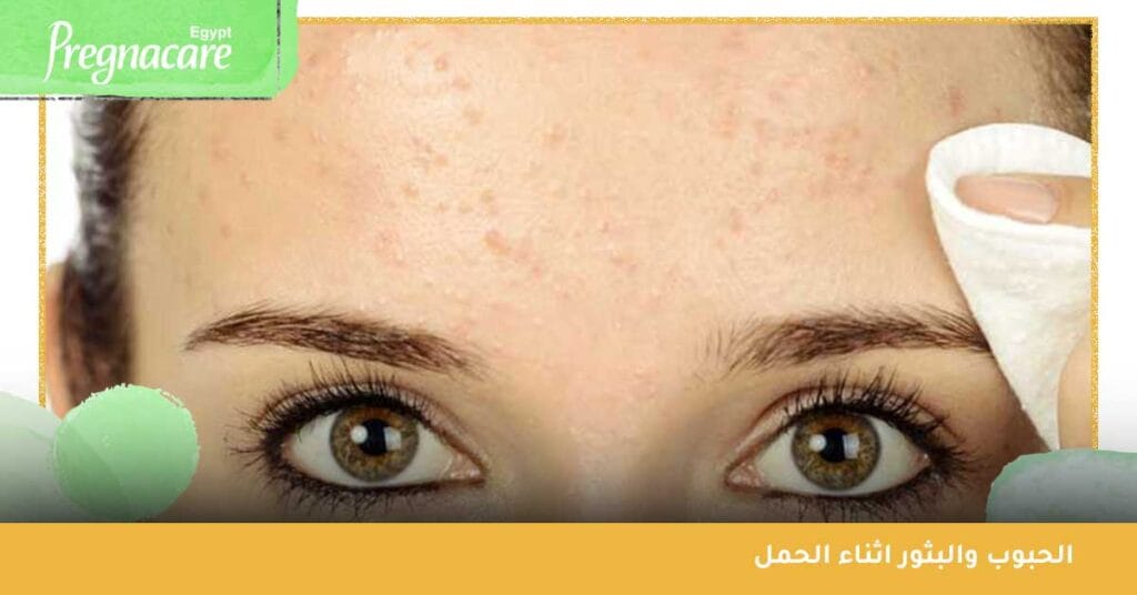 الحبوب والبثور اثناء الحمل