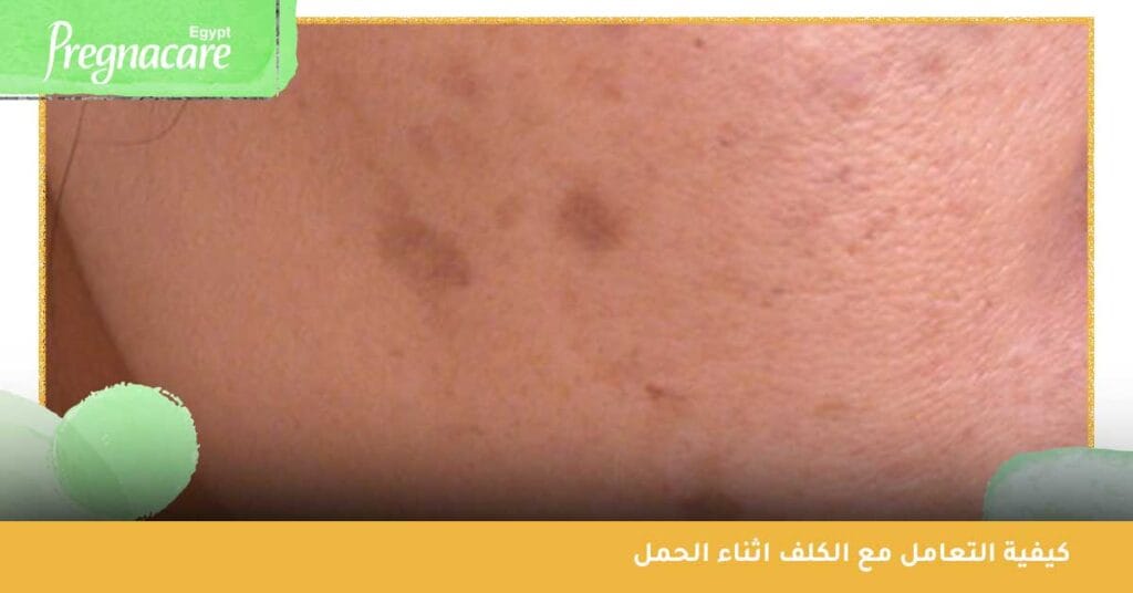 كيفية التعامل مع الكلف اثناء الحمل