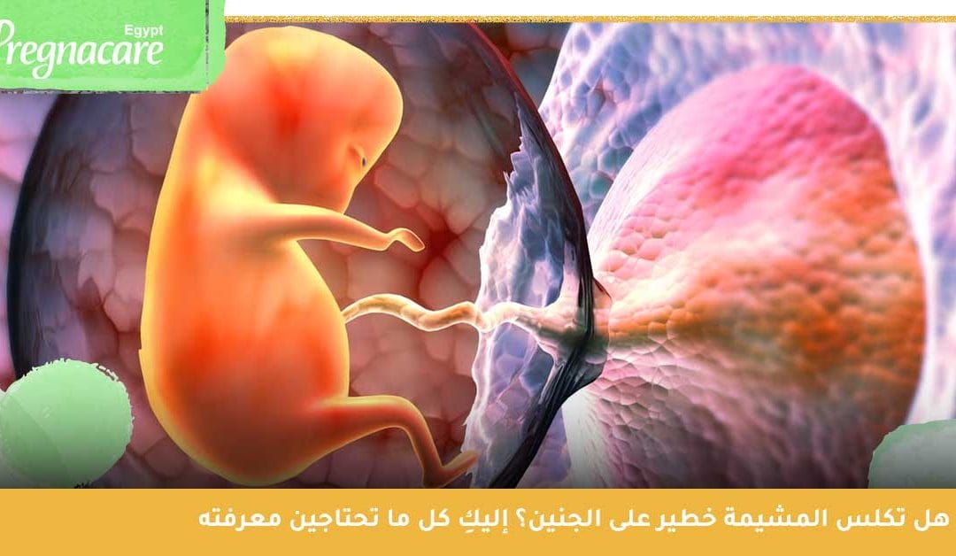 التكلس المشيمي ناقوس خطر يهدد الحمل، فما هو؟